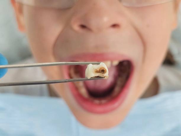 Best Emergency Dentist for Lost Fillings or Crowns in Sierra Ridge, CO